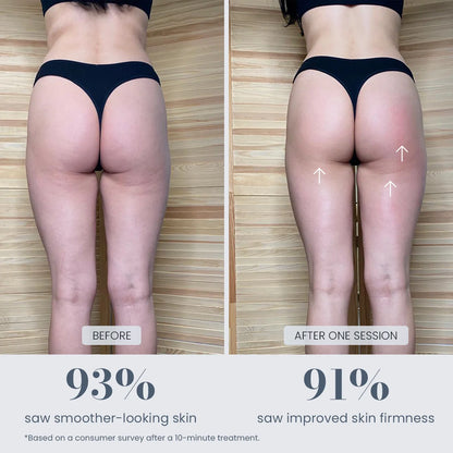 Anti-Cellulite Massager